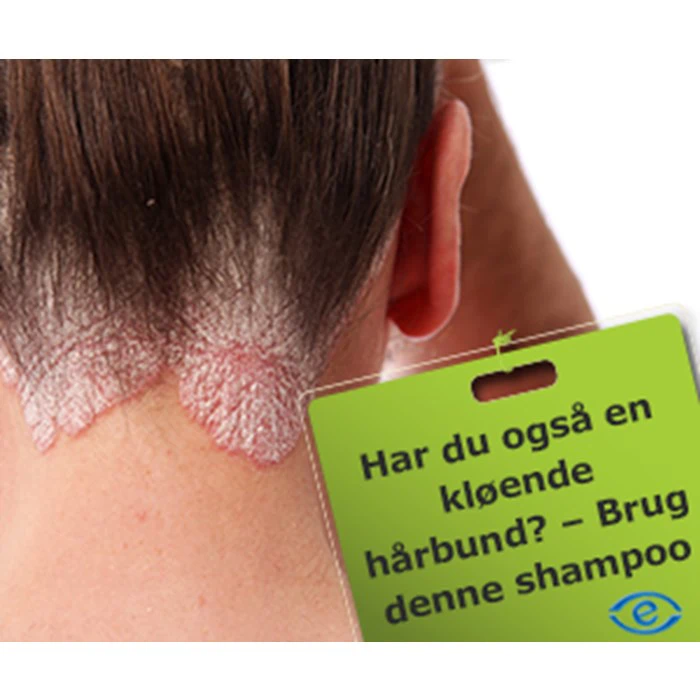 Psoriasis shampoo der lindre godt ved psoriasis i hovedbunden